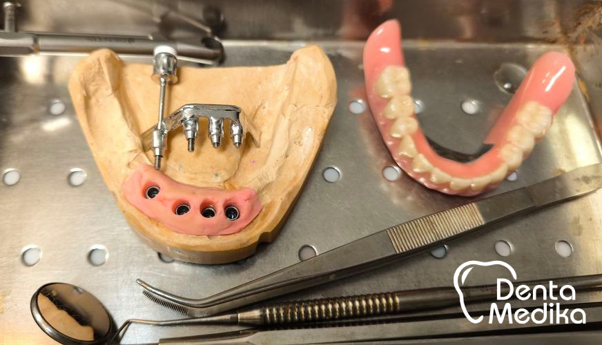 Třmenová hybridní náhrada na implantátech pro bezzubou čelist 2